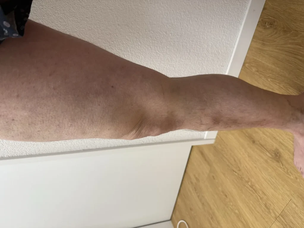 Bein nach der Krampfadertherapie