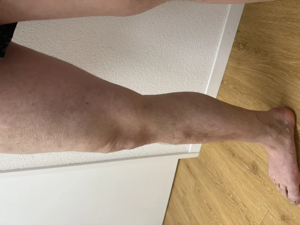 Bein nach der Krampfadertherapie
